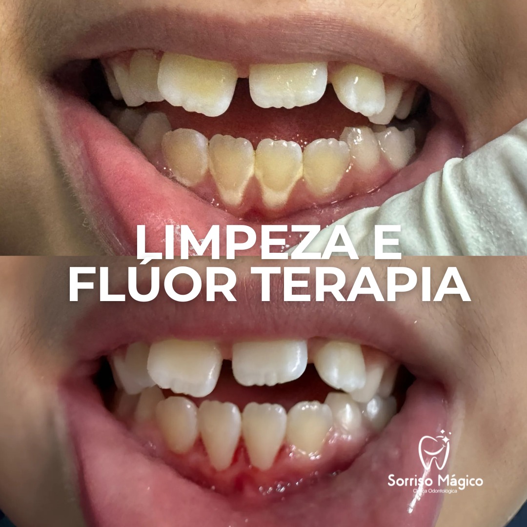 Resultado de tratamento - Limpeza e flúor terapia