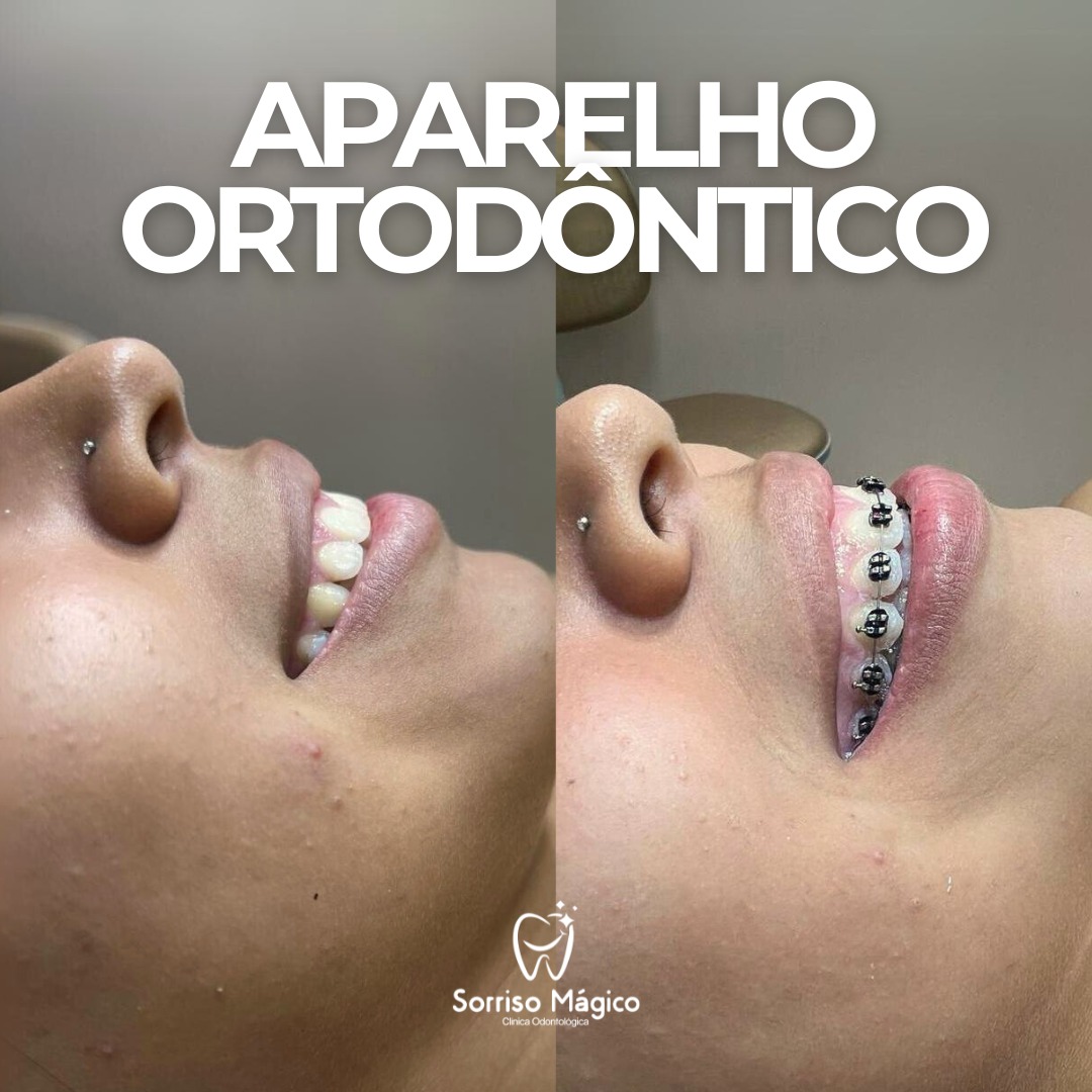 Resultado de tratamento - Aparelho ortodôntico