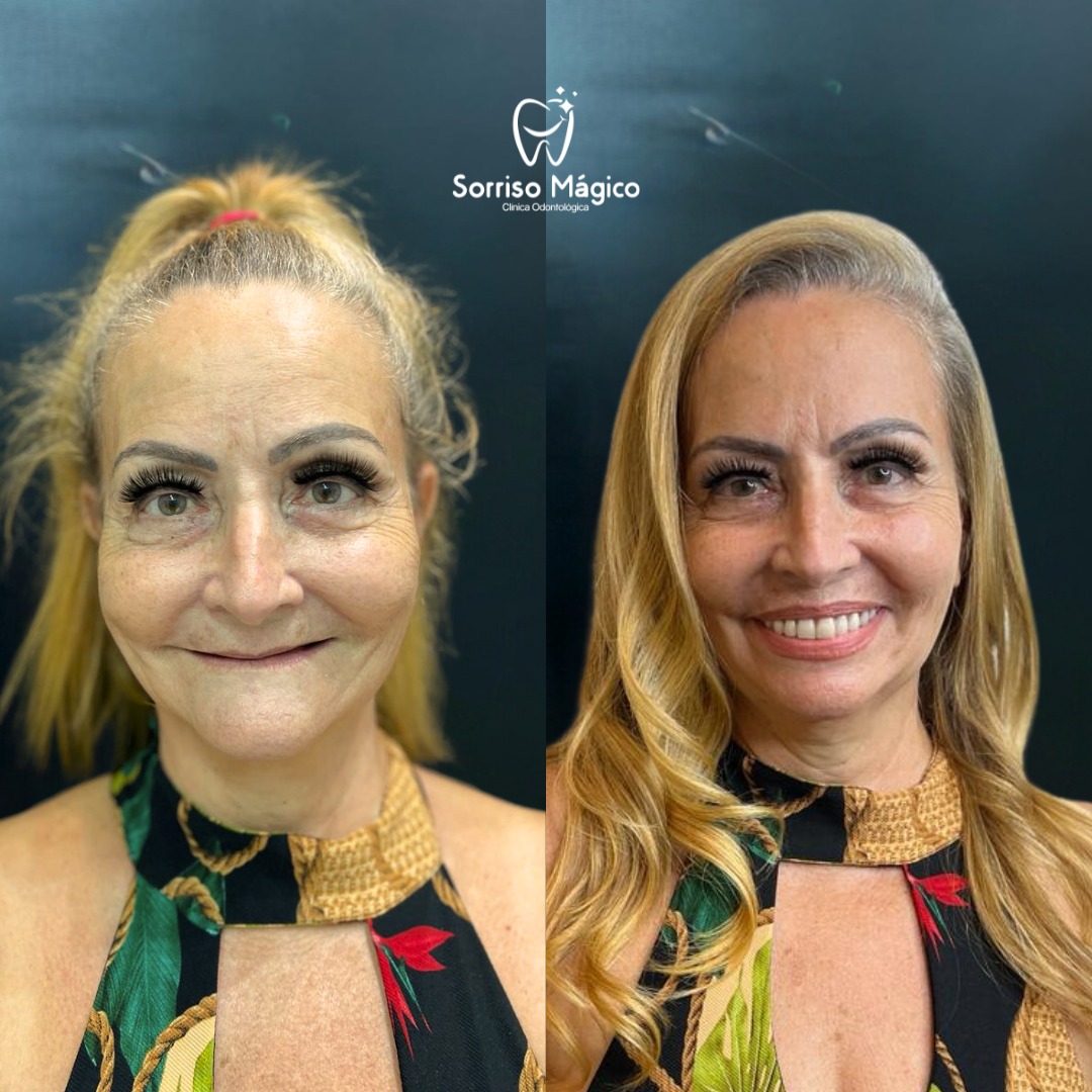 Resultado de tratamento - Reabilitação do sorriso
