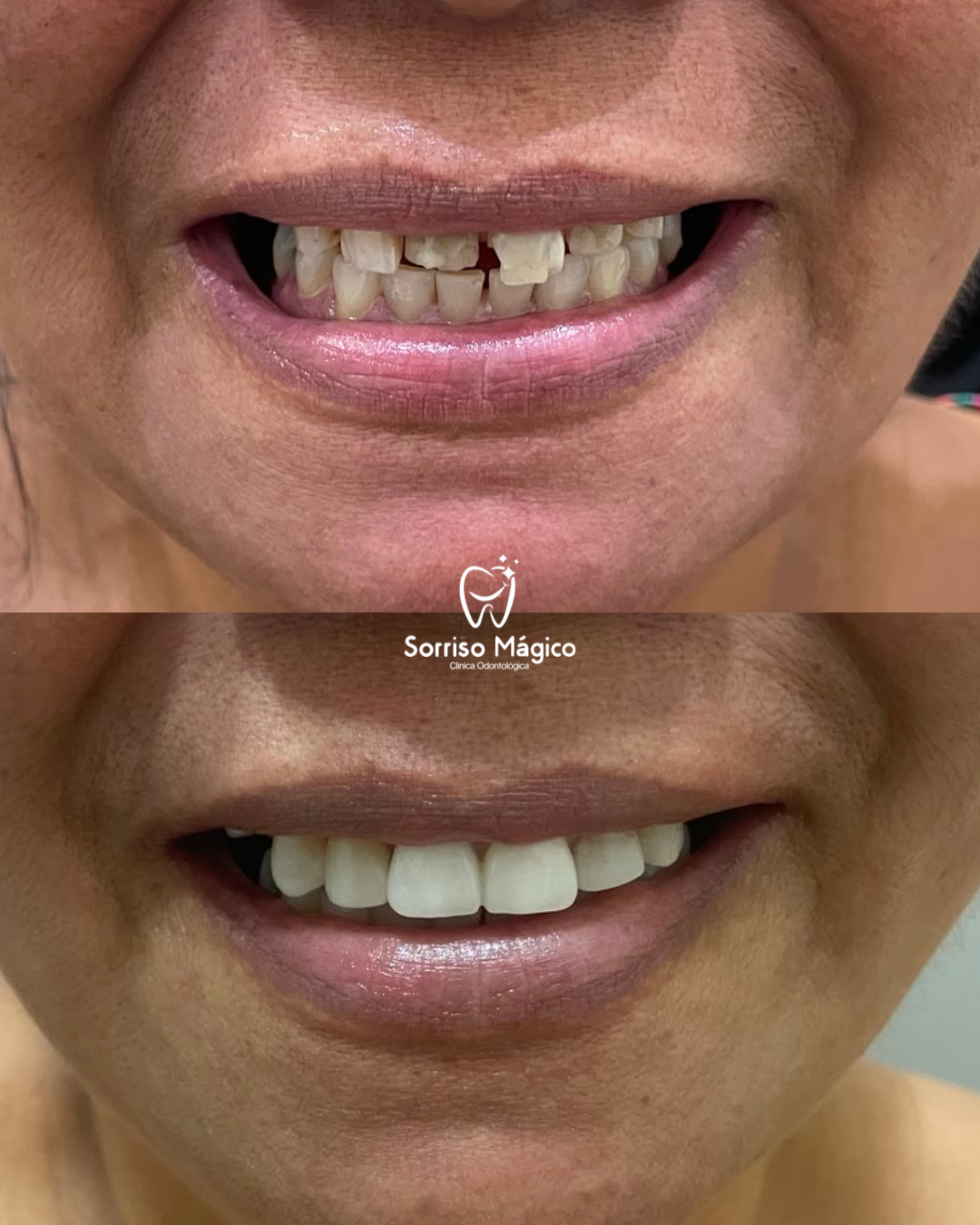 Resultado de tratamento - Reconstrução estética e facetas em resina