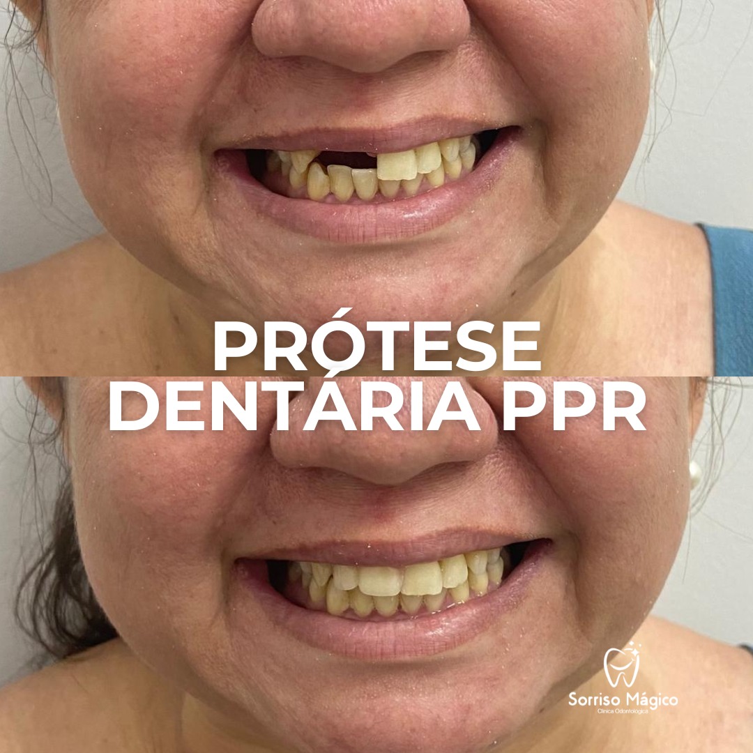 Resultado de tratamento - Prótese dentária PPR