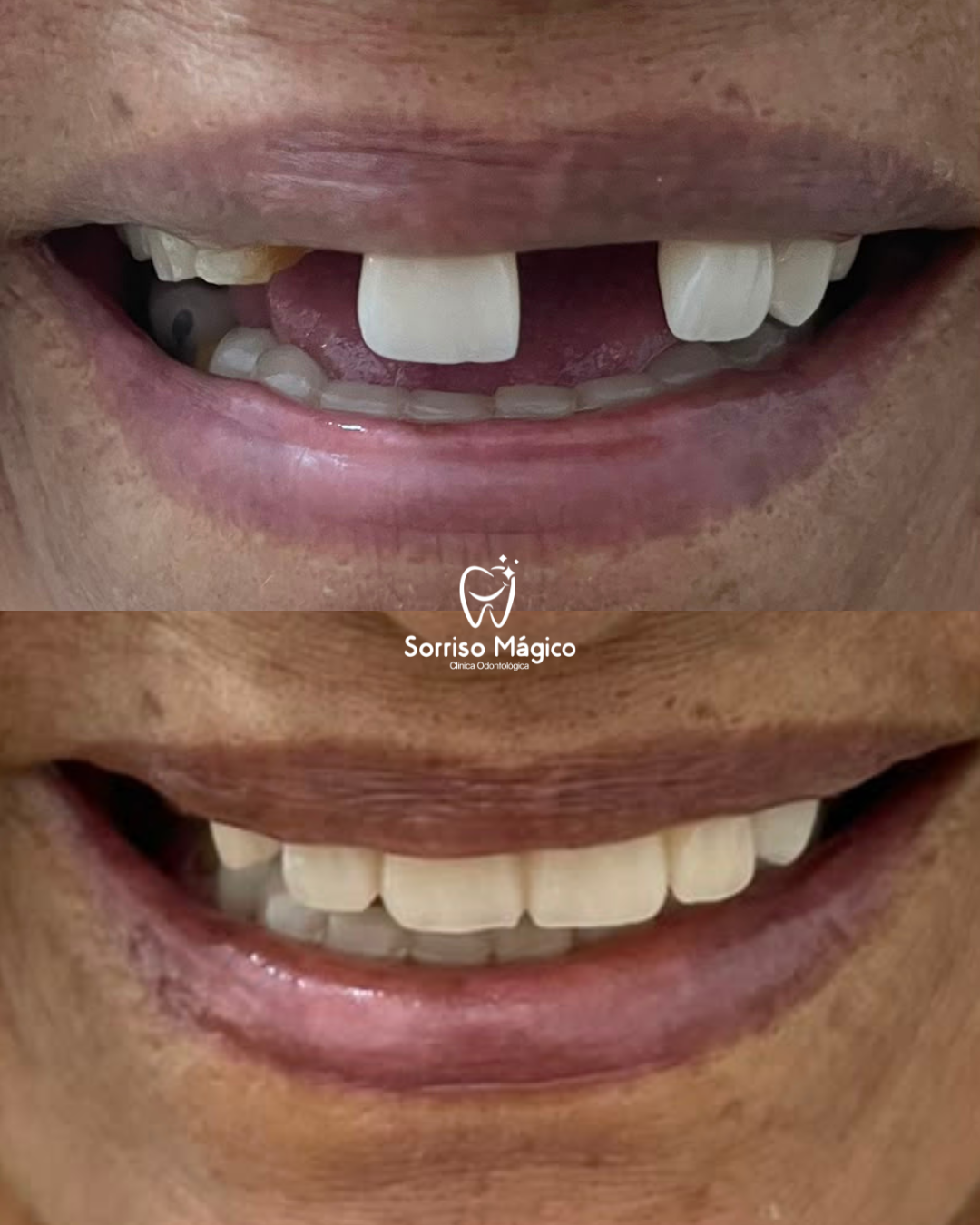 Resultado de tratamento - Prótese fixa sobre dente