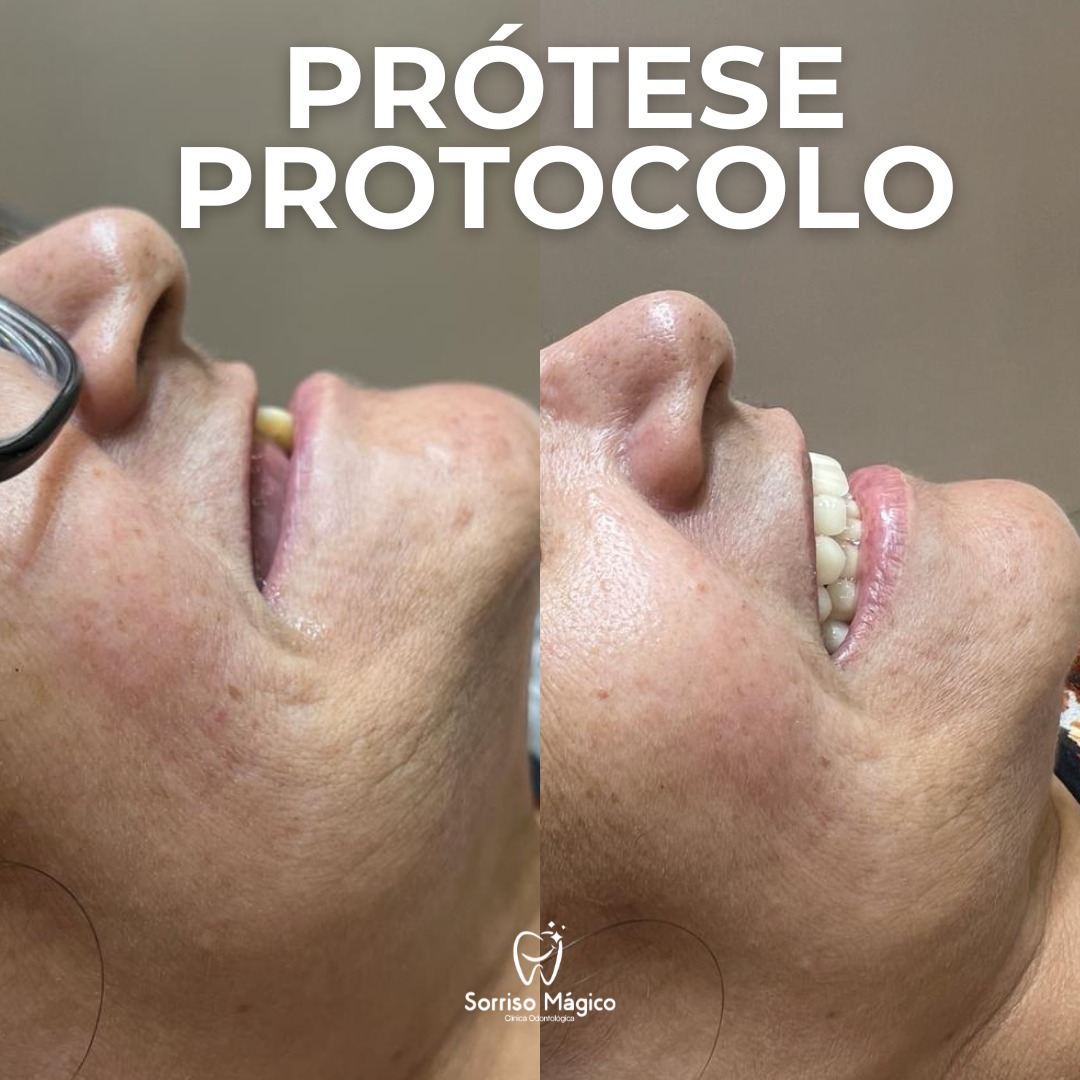 Resultado de tratamento - Prótese protocolo